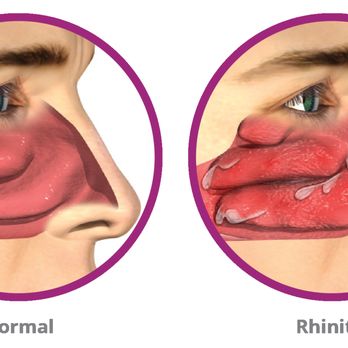 United ENT - Ear Nose & Throat Near Me - Temecula, California United ENT - Ear Nose & Throat Near Me - Temecula, California