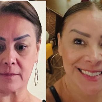 Beauty LA - I had my 11's done, eyes and laugh line - Medical Spas Near Me - La Cañada Flintridge, California Beauty LA - I had my 11's done, eyes and laugh line - Medical Spas Near Me - La Cañada Flintridge, California