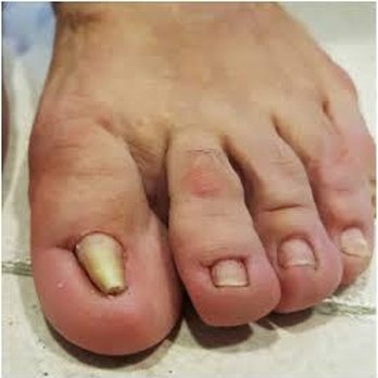 Pedi Care - Uña involuta - Podiatrists Near Me - Puerto Vallarta, JAL