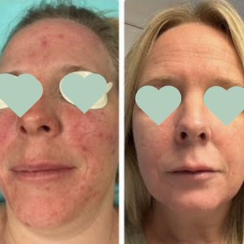 512 Skincare - 2 treatments for redness/rosacea/laxity/sun damage and one laser resurfacing treatment. These results were accomplished in 4 months. - Skin Care Near Me - Austin, Texas 512 Skincare - 2 treatments for redness/rosacea/laxity/sun damage and one laser resurfacing treatment. These results were accomplished in 4 months. - Skin Care Near Me - Austin, Texas