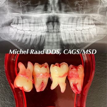 Luxor Dental - Wisdom Tooth Wednesdays!
School's out, smiles are in! Summer is the ideal time for teens to get their wisdom teeth removed! - Cosmetic Dentists Near Me - San Ramon, California Luxor Dental - Wisdom Tooth Wednesdays!
School's out, smiles are in! Summer is the ideal time for teens to get their wisdom teeth removed! - Cosmetic Dentists Near Me - San Ramon, California
