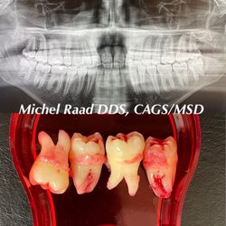 Luxor Dental - Wisdom Tooth Wednesdays!
School's out, smiles are in! Summer is the ideal time for teens to get their wisdom teeth removed!
