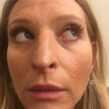 Beautify Your Life - This was the eye redness four days after getting the extensions. - Eyelash Service Near Me - Huntington Beach, California