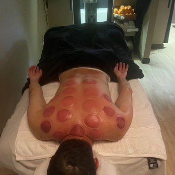 Hawaii Choi Spa - After cupping, redder and darker means greater need for blood circulation in that area. - Day Spas Near Me - Honolulu, Hawaii Hawaii Choi Spa - After cupping, redder and darker means greater need for blood circulation in that area. - Day Spas Near Me - Honolulu, Hawaii