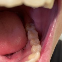 South Pasadena Dental - Post-filling, hard to even spot what was filled! :)