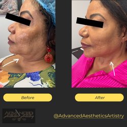 Advanced Aesthetics Artistry - #pdothreadlift 4784448651