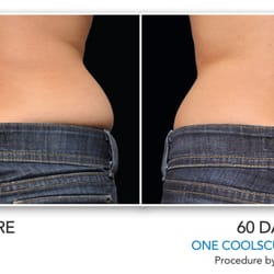 Afterglow Physician Directed Medical Aesthetics - Coolsculpting: Non-surgical fat reduction treatment for stubborn pockets of fat. Safe and effective!