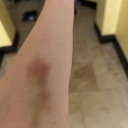 Labcorp - My blown out vein two weeks later