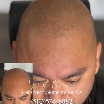 Scalp Micro Pigmentation - 2nd session SMP RESULTS BY Joe V. Nguyen - Hair Loss Centers Near Me - San Lorenzo, California Scalp Micro Pigmentation - 2nd session SMP RESULTS BY Joe V. Nguyen - Hair Loss Centers Near Me - San Lorenzo, California