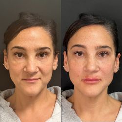 Skin MD - Facial fillers restore volume, enhance facial structure, & smooth deeper lines--perfect for cheeks, jawline, under-eyes, and more.