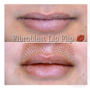 Distinctive Lashes & Beauty - Plasma Fibroblast Skin Tightening - Eyelash Service Near Me - Smyrna, Georgia Distinctive Lashes & Beauty - Plasma Fibroblast Skin Tightening - Eyelash Service Near Me - Smyrna, Georgia