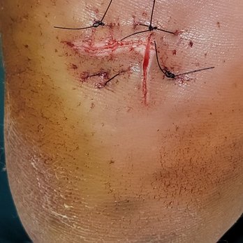 Ciaran Jacka DPM - Clearly went cut happy on something that was the size of a hangnail - Podiatrists Near Me - San Leandro, California