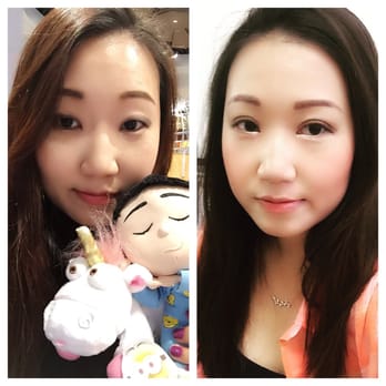 VIP Plastic Surgery - Before and after. 3months. - Cosmetic Surgeons Near Me - Los Angeles, California