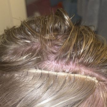 Kat Pro Studio - My scalp is clearly red and irritated after trying to wash my hair for the first time - Hair Extensions Near Me - Castle Rock, Colorado Kat Pro Studio - My scalp is clearly red and irritated after trying to wash my hair for the first time - Hair Extensions Near Me - Castle Rock, Colorado