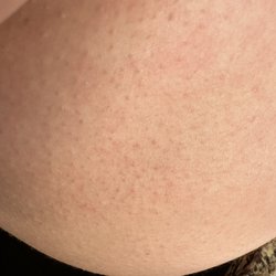 Anne Arundel Dermatology - Glen Burnie - Allergic reaction to Bacitracin!!!