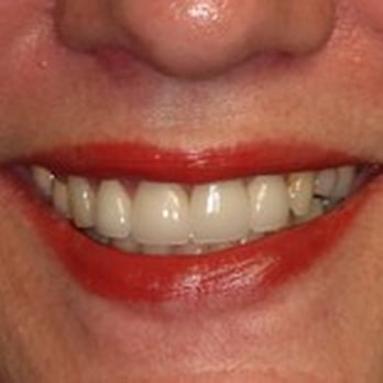 Stone Oak Dental - After Veneers - Cosmetic Dentists Near Me - San Antonio, Texas Stone Oak Dental - After Veneers - Cosmetic Dentists Near Me - San Antonio, Texas