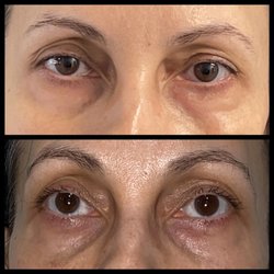 Vanity Skin Bar - Eyebrow lift with PDO threads reduced eye hooding