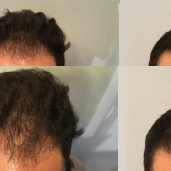 Marc Dauer, MD - Hair Loss Centers Near Me - Los Angeles, California Marc Dauer, MD - Hair Loss Centers Near Me - Los Angeles, California