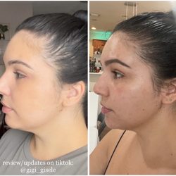 Elite Medical Aesthetics - Week 1 vs Week 6 -- after 1 session.