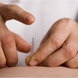 Chiropractic Natural Care Center - Relieve pain with Acupuncture in Lauderhill.