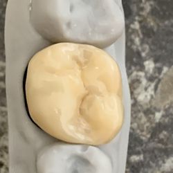 CM Dental - All porcelain crown preparation and ready for patient work by Dr Martin Cribbin at CM Dental