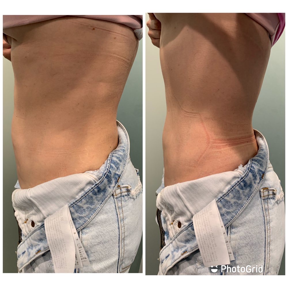 Abdomen Emsculpt