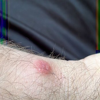 Americas Best Value Inn Torrington, CT - Bed bug bites on all of us - Hotels Near Me - Torrington, Connecticut