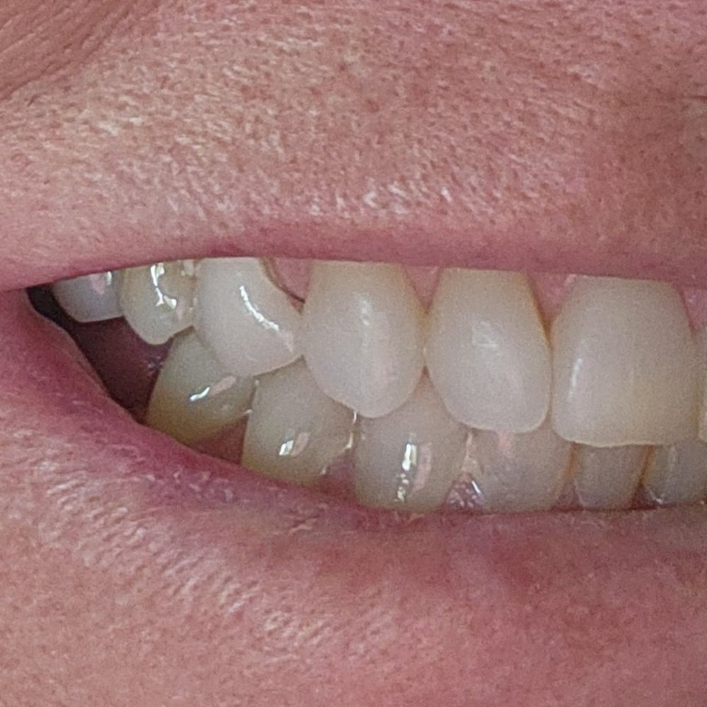 You can clearly see the crooked crown. Which was not a crooked tooth ! You can clearly see the crooked crown. Which was not a crooked tooth !