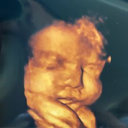 Expectations Ultrasound - 32 weeks