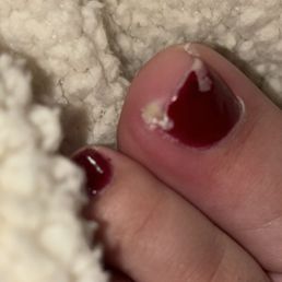Toe infected