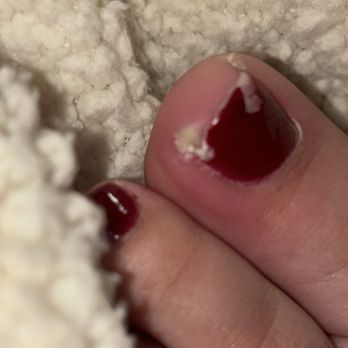 Carmel Valley Nail Lounge - Toe infected - Nail Salons Near Me - San Diego, California