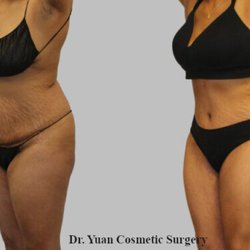Sean Yuan, MD - Tummy tuck under local result.