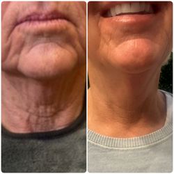 ZenVita Med Spa - Morpheus8 & Hyperdilute Radiesse