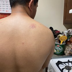 Z Relax On Union - Thats a bruise that he did not have before the massage.