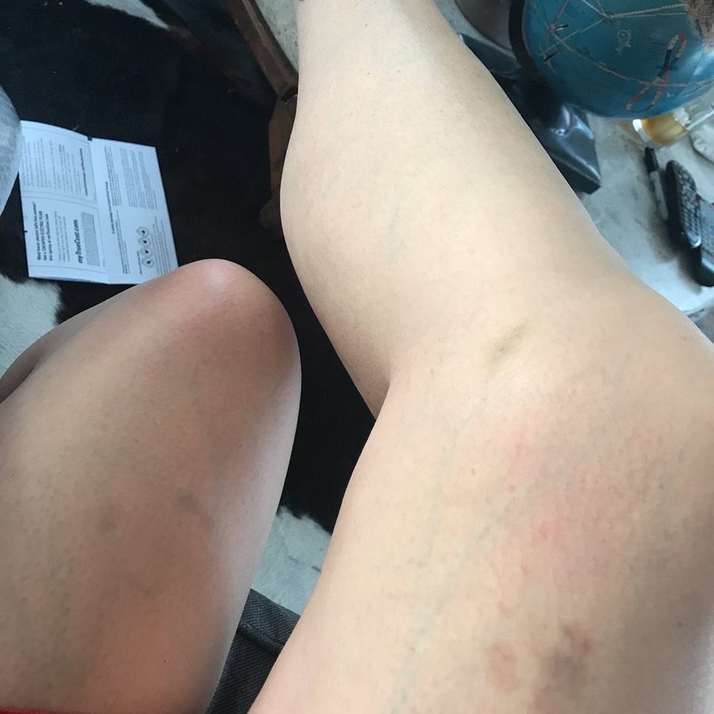 Plummer Chiropractic and Accident Center - My bruised leg - Chiropractors Near Me - Englewood, Florida Plummer Chiropractic and Accident Center - My bruised leg - Chiropractors Near Me - Englewood, Florida
