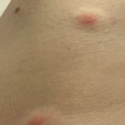 The Avenue - Bedbug bites within 4 hours of sitting in their outdoor sodas.