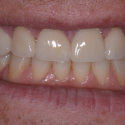 Michael A. Shustak, DMD - Sample 1: After treatment photograph (see our website for more photographs)