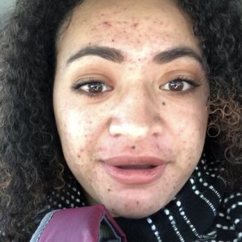 Beautifully Blessed Skin Studio - This was the day after my first treatment. - Estheticians Near Me - Fremont, California Beautifully Blessed Skin Studio - This was the day after my first treatment. - Estheticians Near Me - Fremont, California