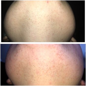 LaserAway - The top is November 2018, after 10 treatments. The bottom is September 2019, after 17 treatments. Zero results. - Laser Hair Removal Near Me - Walnut Creek, California LaserAway - The top is November 2018, after 10 treatments. The bottom is September 2019, after 17 treatments. Zero results. - Laser Hair Removal Near Me - Walnut Creek, California