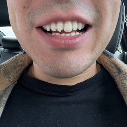 Broken teeth Broken teeth