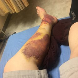 Concentra Urgent Care - They looked at this and told me I was ok to work with no restrictions.
