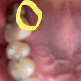 Went for a cavity filling came out with a chunk of soft tissue gone