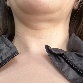 David H. Gilbert DDS, MS, MBA, FACS - Obvious over suction on right side in one area - Oral Surgeons Near Me - Upland, California David H. Gilbert DDS, MS, MBA, FACS - Obvious over suction on right side in one area - Oral Surgeons Near Me - Upland, California