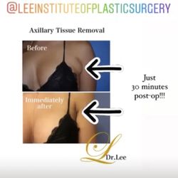 Lee Institute of Plastic Surgery - Armpit fat removal.