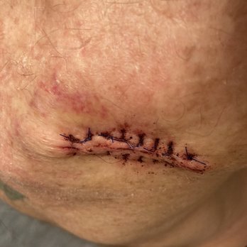 Schweiger Dermatology Group - 3days later - Dermatologists Near Me - Great Neck, New York