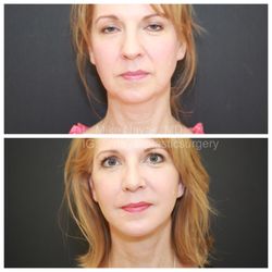 Nayak Plastic Surgery - 6 weeks post Deep Necklift, Deep Plane Facelift, Rhinoplasty, Buccal Fat Removal and Chin Implant