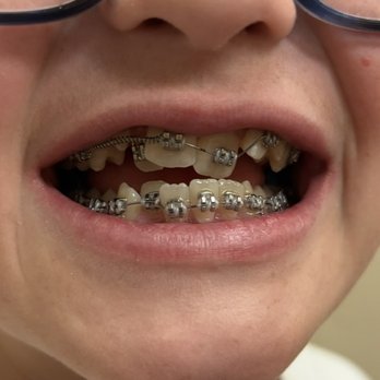 Leber Orthodontics - First day with braces - Orthodontists Near Me - Tucson, Arizona Leber Orthodontics - First day with braces - Orthodontists Near Me - Tucson, Arizona