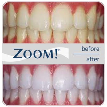 Elliot M Razdolsky, DDS - Zoom whitening treatment on the teeth. - General Dentistry Near Me - Buffalo Grove, Illinois Elliot M Razdolsky, DDS - Zoom whitening treatment on the teeth. - General Dentistry Near Me - Buffalo Grove, Illinois