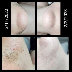 Modesty Electrology - Amazing results after 1 year of treatment thanks to Joy - PCOS hirsutism on chin, before and after