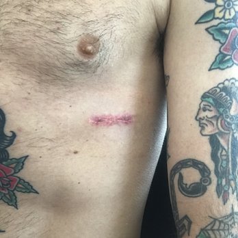 Michael P Tabibian, MD - They didn't want to give me antibiotics after my surgery & now it appears to be infected. - Dermatologists Near Me - Los Alamitos, California Michael P Tabibian, MD - They didn't want to give me antibiotics after my surgery & now it appears to be infected. - Dermatologists Near Me - Los Alamitos, California